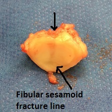 sesamoid fracture 